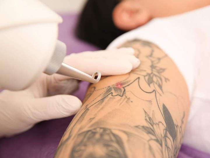 Effacez les tatouages indésirables grâce à notre technologie laser avancée.